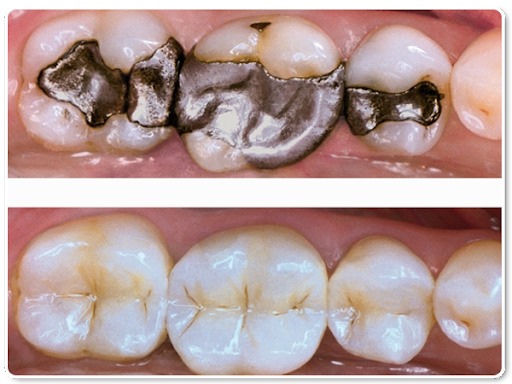 aston dental MERCURY FREE RESTORATION (TOOTH COLOURED FILLING)