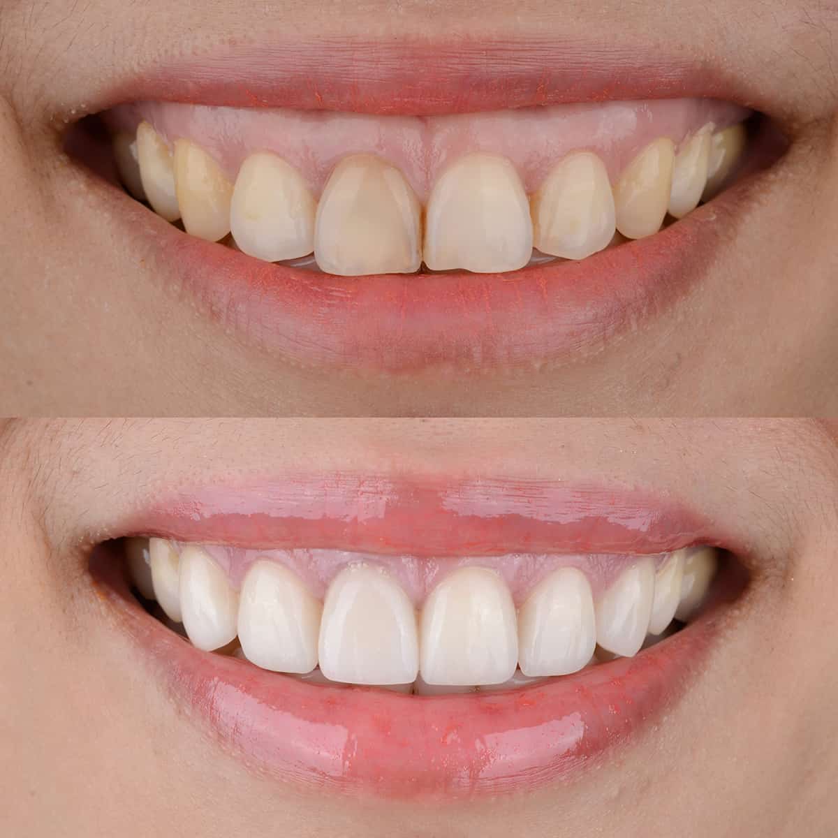 aston dental MERCURY FREE RESTORATION (TOOTH COLOURED FILLING)