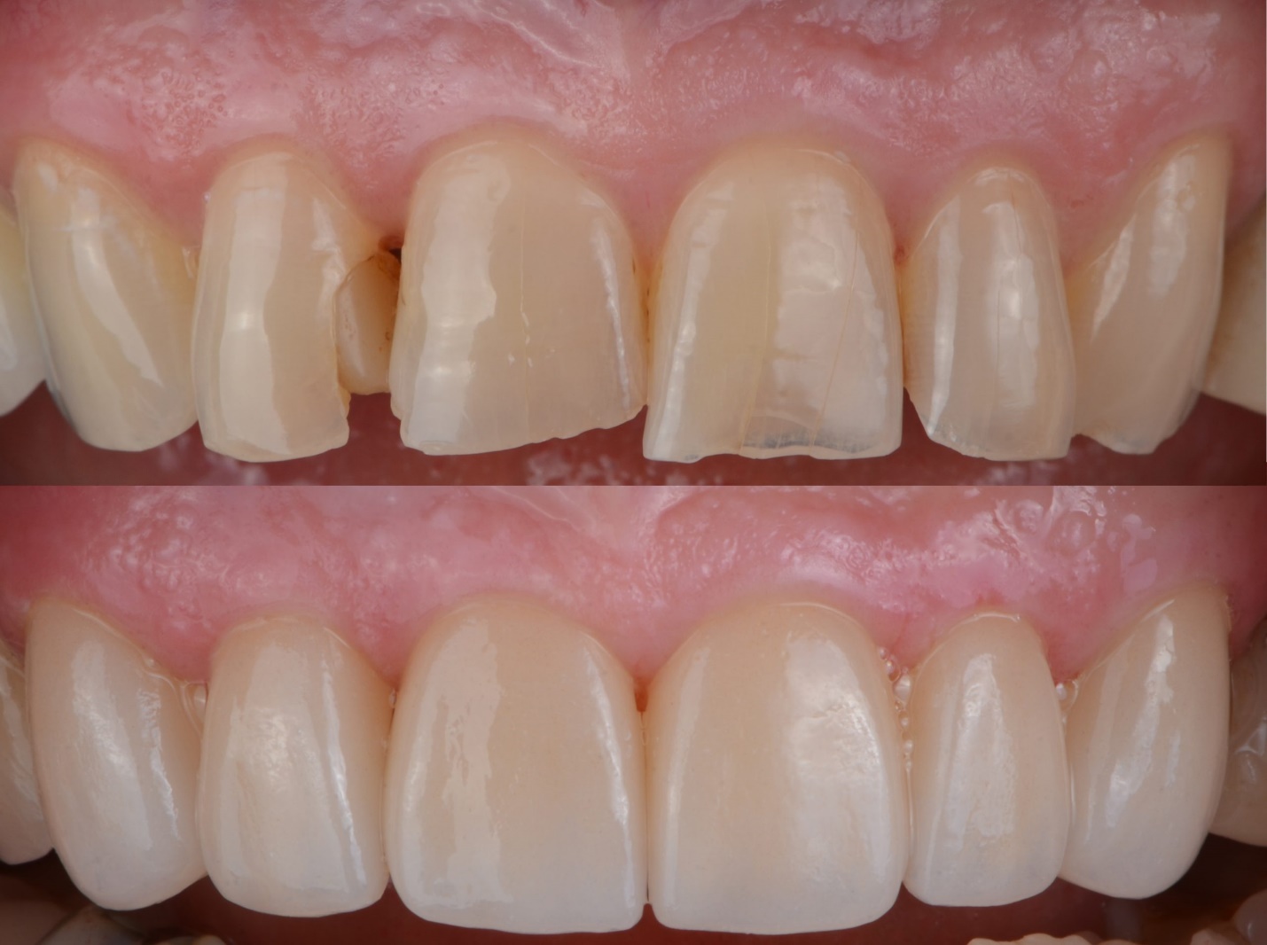 aston dental MERCURY FREE RESTORATION (TOOTH COLOURED FILLING)