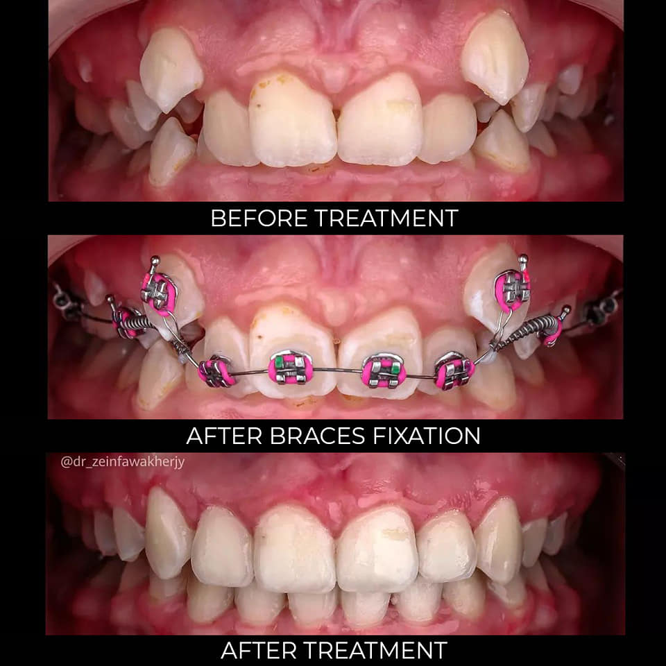 aston dental MERCURY FREE RESTORATION (TOOTH COLOURED FILLING)