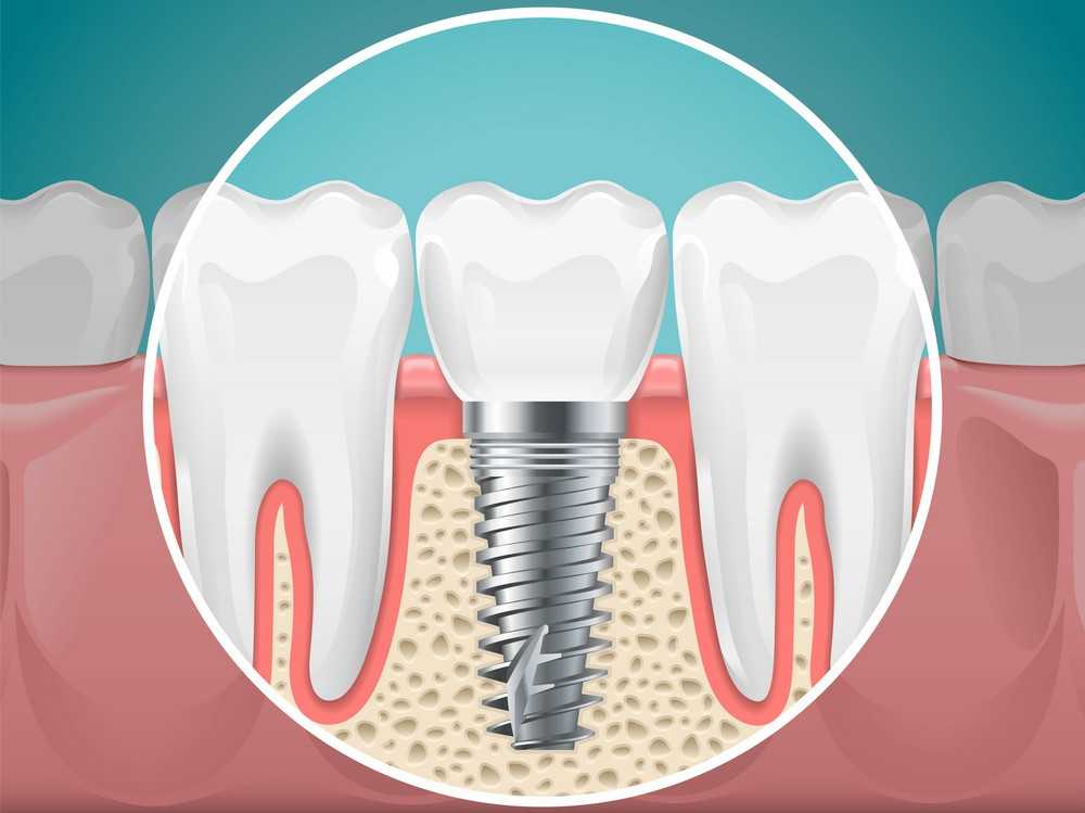 aston dental MERCURY FREE RESTORATION (TOOTH COLOURED FILLING)