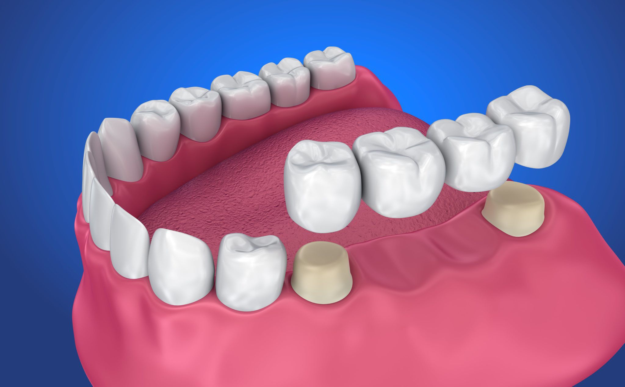 aston dental MERCURY FREE RESTORATION (TOOTH COLOURED FILLING)