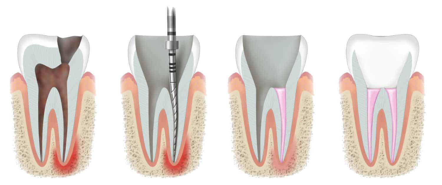 aston dental MERCURY FREE RESTORATION (TOOTH COLOURED FILLING)