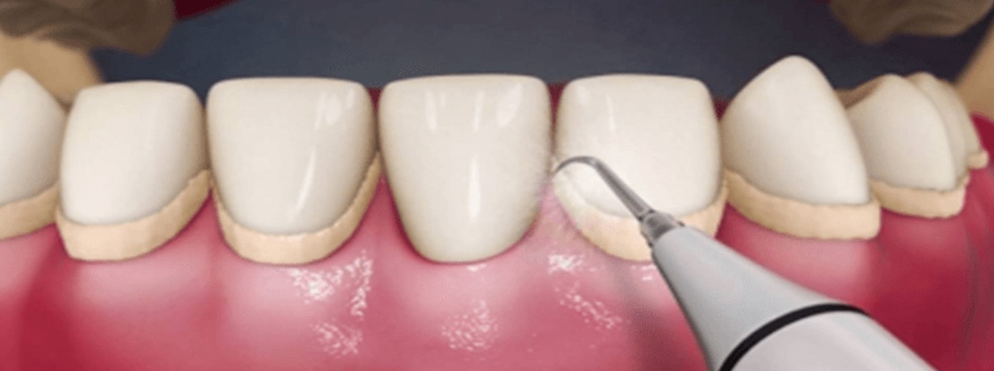 aston dental MERCURY FREE RESTORATION (TOOTH COLOURED FILLING)