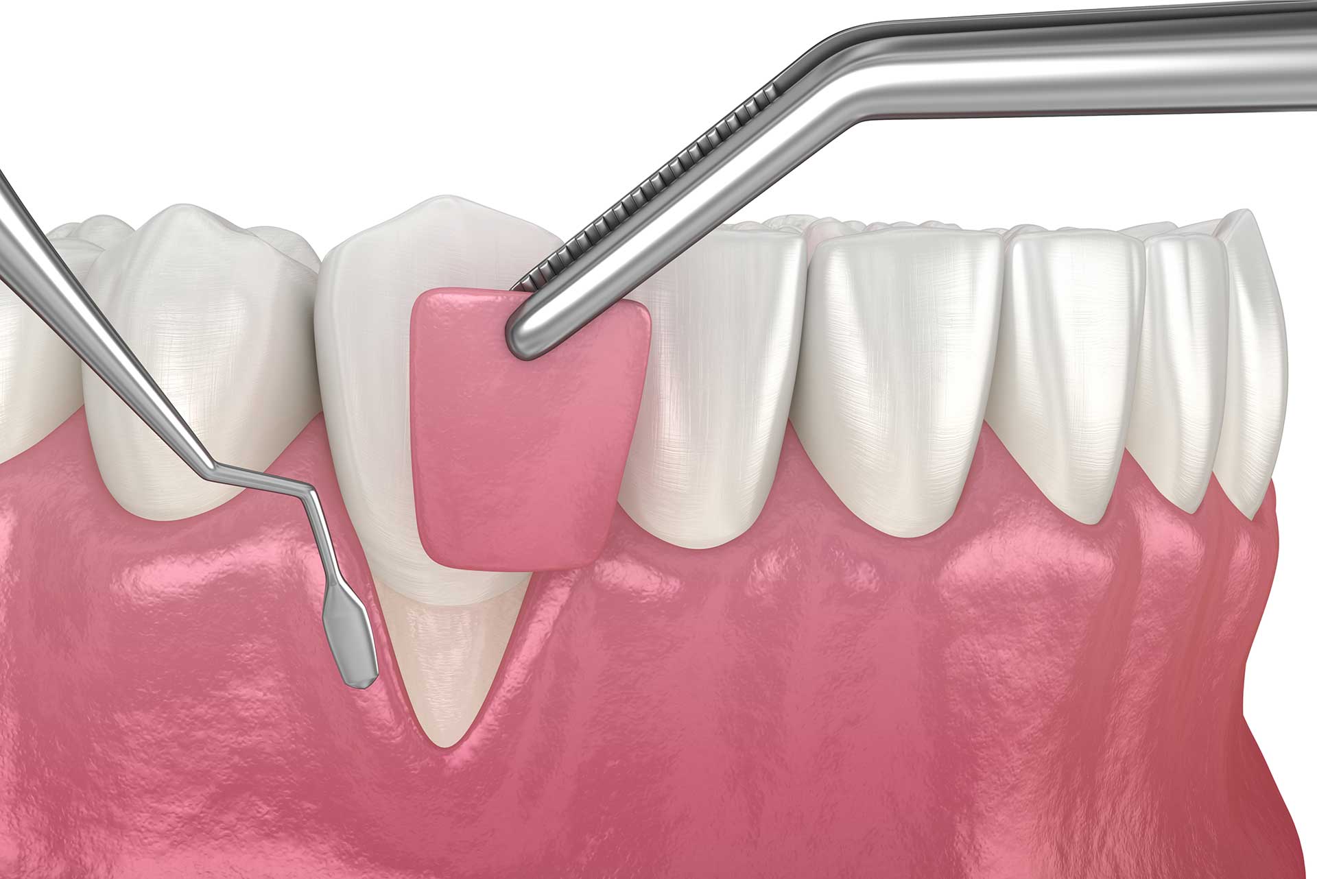 aston dental MERCURY FREE RESTORATION (TOOTH COLOURED FILLING)