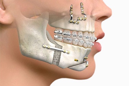 aston dental MERCURY FREE RESTORATION (TOOTH COLOURED FILLING)